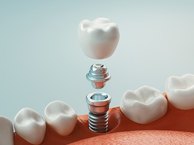 A 3D illustration of a dental implant’s various parts