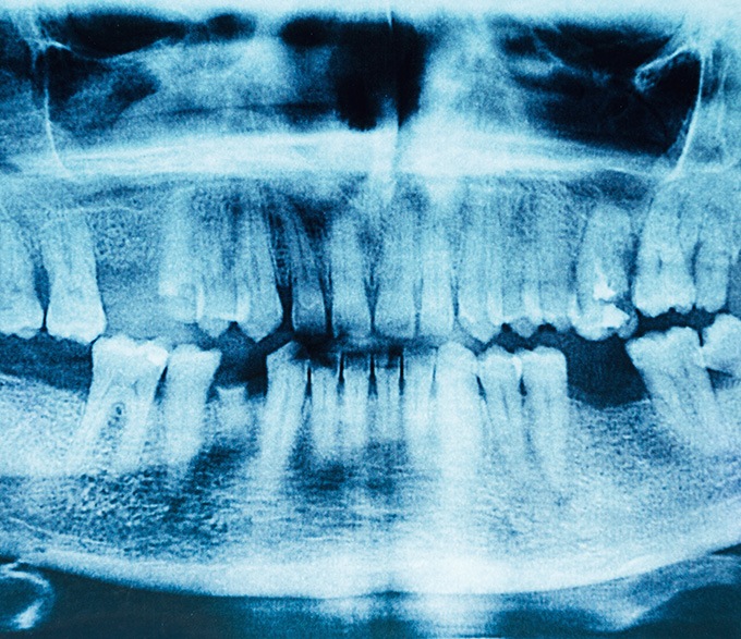 an X-ray showing of a person’s mouth