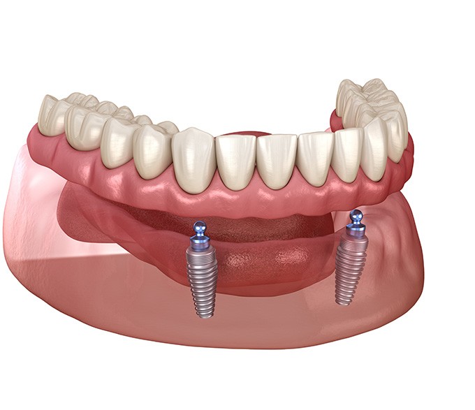 a digital illustration showing implant dentures