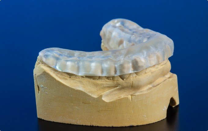 Clear nightguard on top of model of lower arch of teeth