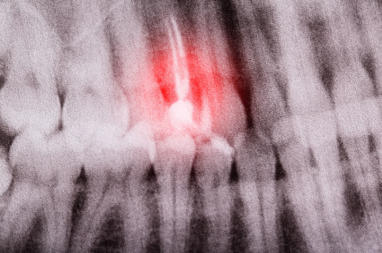 xray image of a toothe needing root canal therapy 